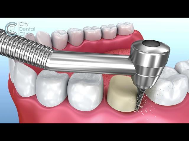 Zahnkrone Behandlungsablauf Animation