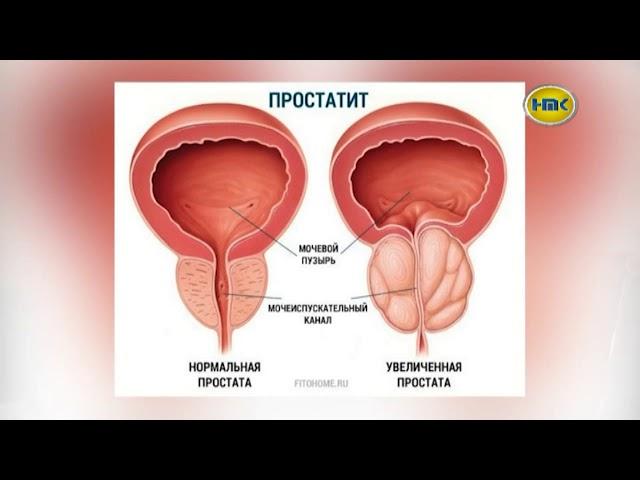 ЛДЦ «Медицина» диагностика  и лечение простатита   – выпуск №17 2017 г