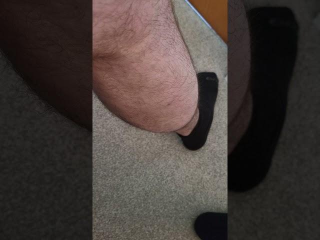 benign fasciculation syndrome - calf muscles