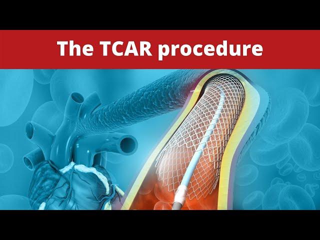 The TCAR procedure