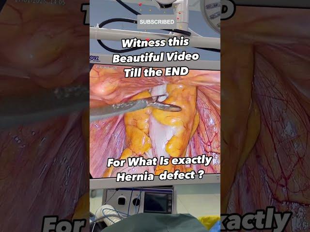What EXACTLY is HERNIA DEFECT ? Hernia Surgery I Hernia Operation I Inguinal Hernia I India I Surat