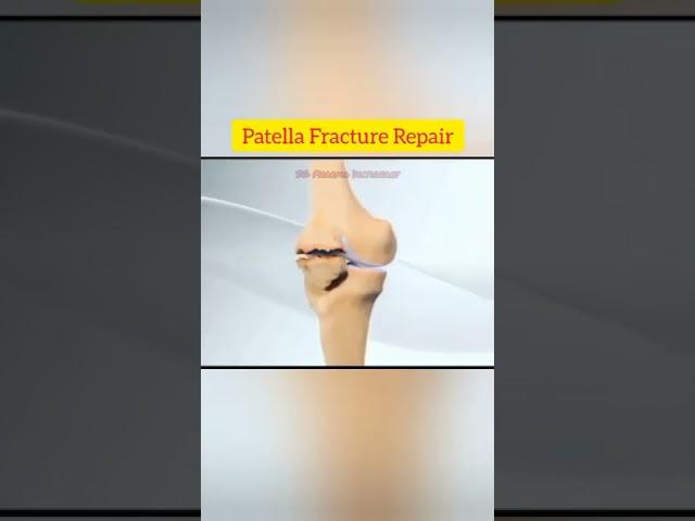 Patella Fracture Repair ll Animation ll @SG Pharma Dictionary