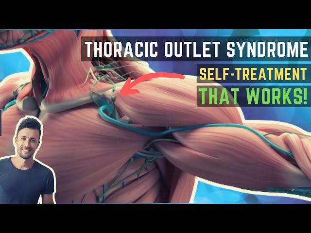 Thoracic Outlet Syndrome Treatment That Actually Works!