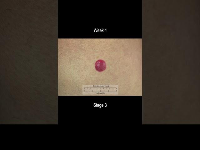 Merkel Cell Carcinoma Development Time Lapse - More Deadly Than Melanoma!