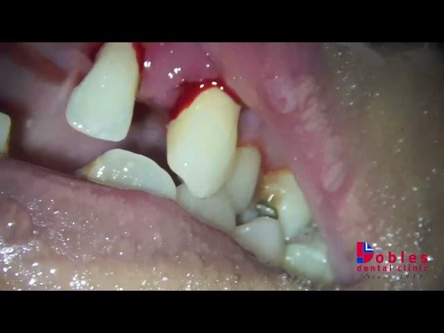 Dental Cleaning with Large Chunks of Tartar