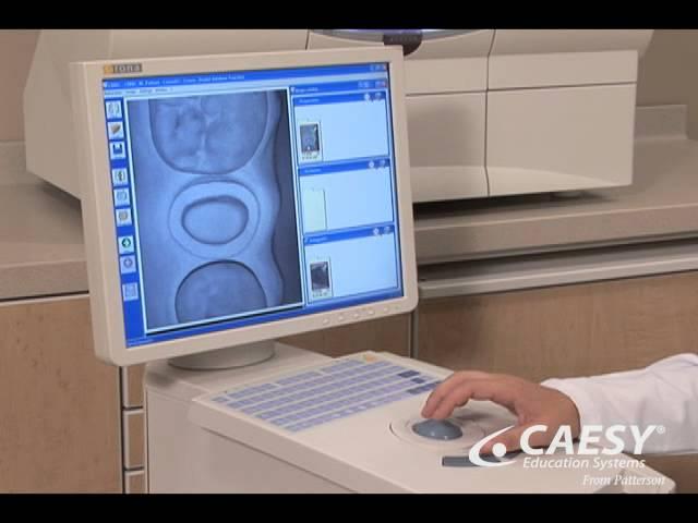 Crowns CADCAM Restoration Procedure