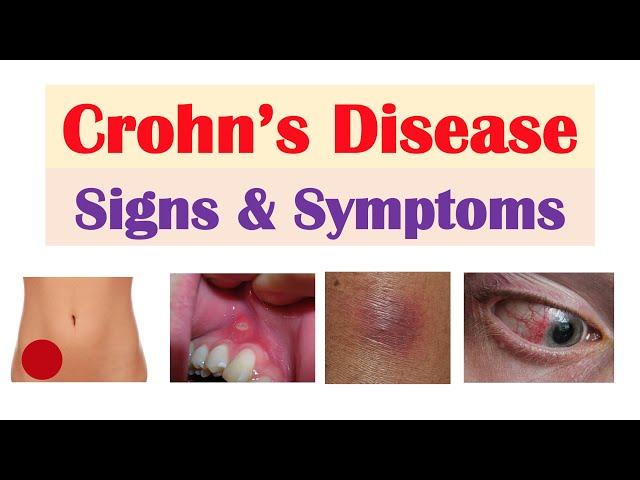 Crohn’s Disease Signs and Symptoms (& Why They Occur), and Complications & Deficiencies