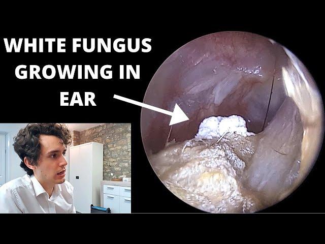 White Fur Growing in Ear Removed With Suction (Otomycosis Fungal Infection)