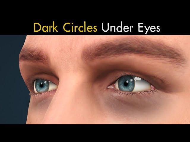 What Causes Dark Circles Under Eyes? | Symptoms, Causes And Treatment of Dark Circles Under Eyes