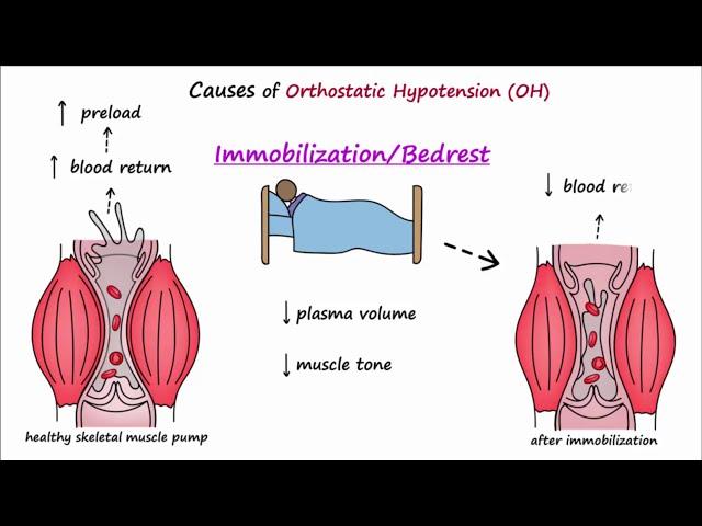 Orthostatic Hypotension (Described Concisely)