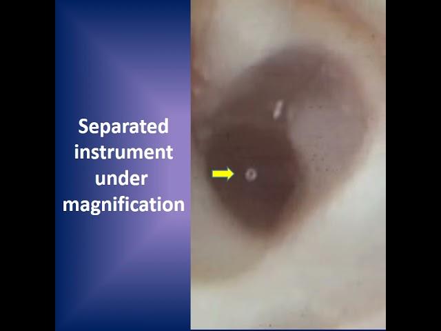 Bypassing a separated instrument in a root canal