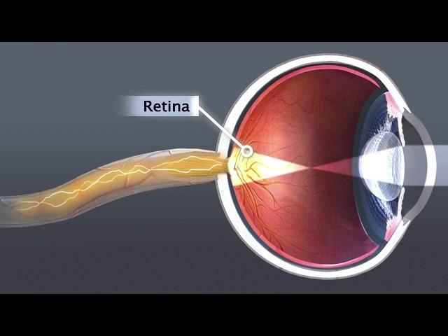 Animation: Cataract