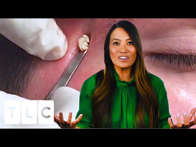 The Beautiful Blackheads |  Dr Pimple Popper: This Is Zit