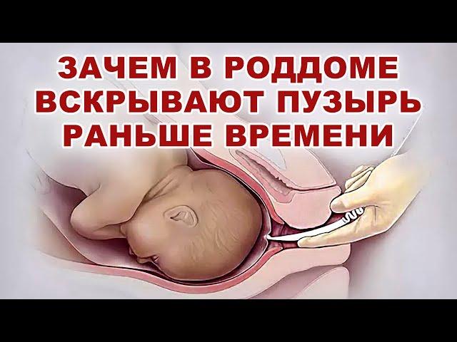 Когда вскрытие плодного пузыря опасно для родов? Зачем вскрывают плодный пузырь раньше времени?