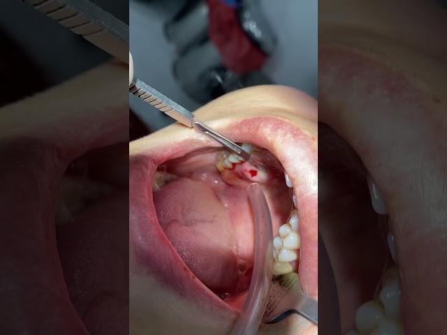 Palatinal apse drenajı //palatinal dental abscess drainage.