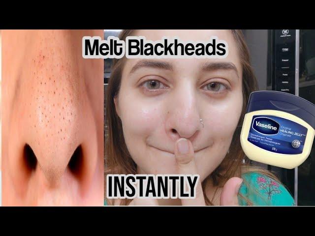 I Removed My Blackheads Instantly Korean trick. how to get rid of blackheads