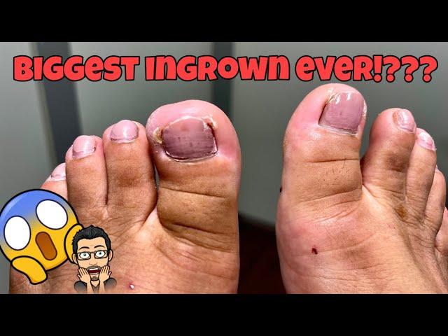 DOUBLE INGROWN TOENAIL REMOVAL 