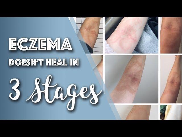 How Eczema ACTUALLY Heals (You Might be Surprised) // Michelle Mills