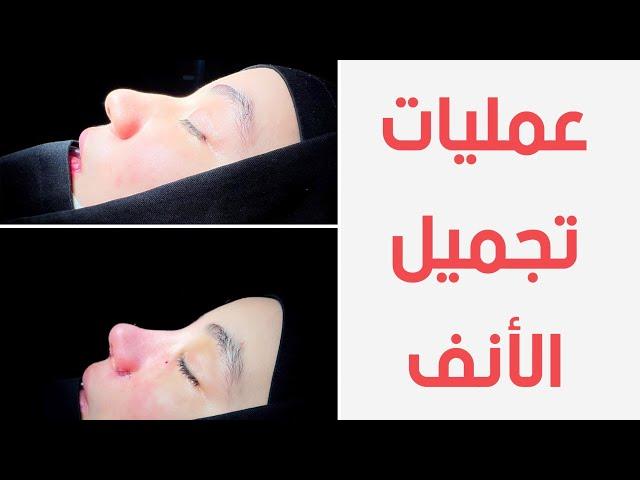 كل ما تريد معرفته عن عمليات تجميل الأنف