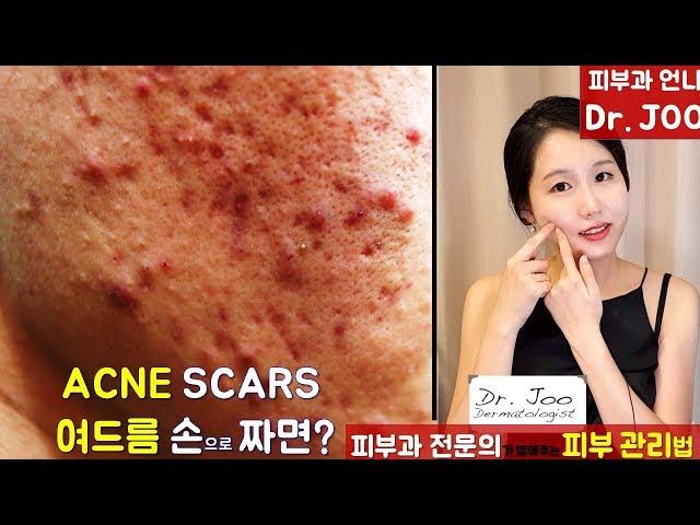 (*Eng Sub) 피부과전문의가 알려주는 여드름 스킨케어ㅣ How to Prevent Acne Scar by a Dermatologistㅣ여드름 흉터 예방법