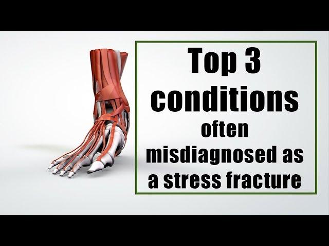 Top 3 conditions often misdiagnosed as a stress fracture in a runner