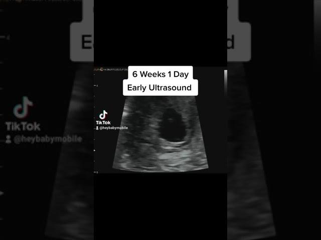 Heartbeat on Early Ultrasound at 6 Weeks 1 Day Pregnant