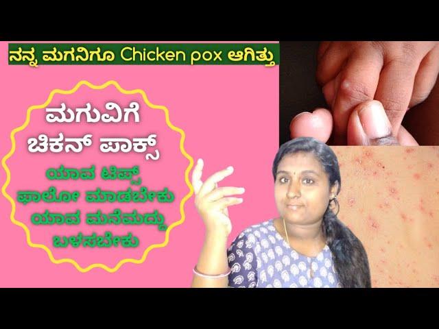 ಮಕ್ಕಳಲ್ಲಿ chickenpox ಪರಿಹಾರಗಳು  । chickenpox in babies and kids । Chickenpox home remedies