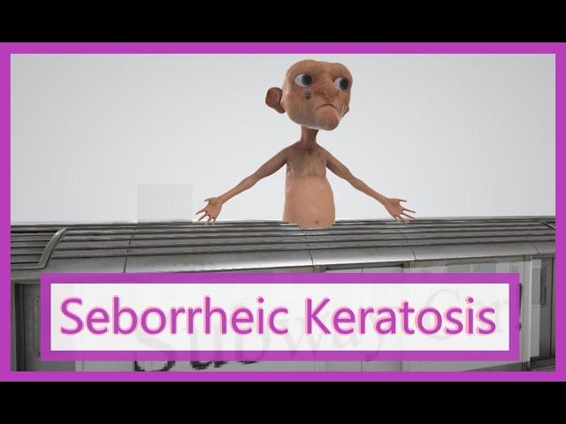 Seborrheic Keratosis (Mnemonic for the USMLE)