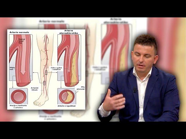 Probleme me arteriet e këmbëve? Ja kur duhet të shqetësoheni dhe çfarë fshehin | ABC News Albania