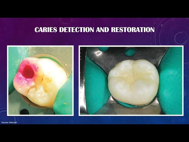 Basic and Advanced treatment modalities pertaining to Conservative dentistry and Endodontics.