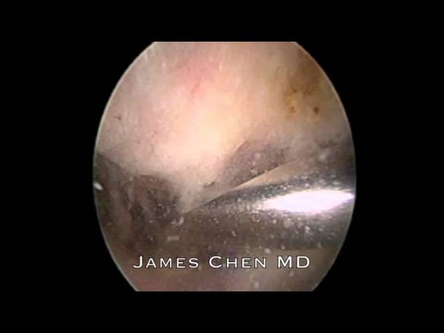 Arthroscopic Subacromial Decompression with Burr