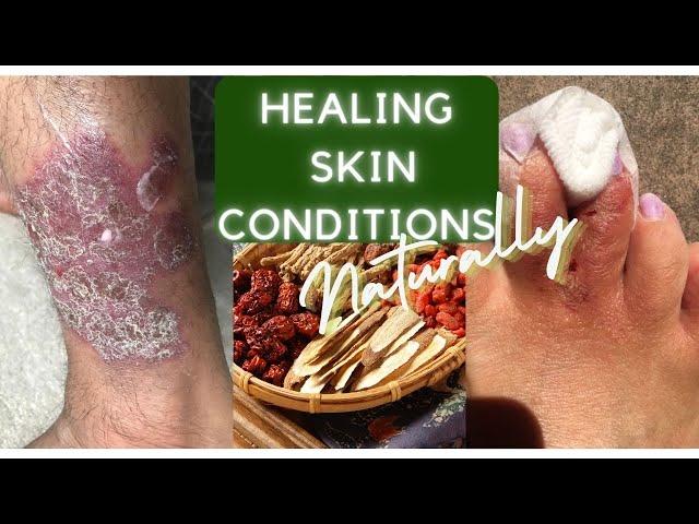 Can DIFFICULT SKIN CONDITIONS be HEALED NATURALLY? No Medication. Only HERBS & DIET