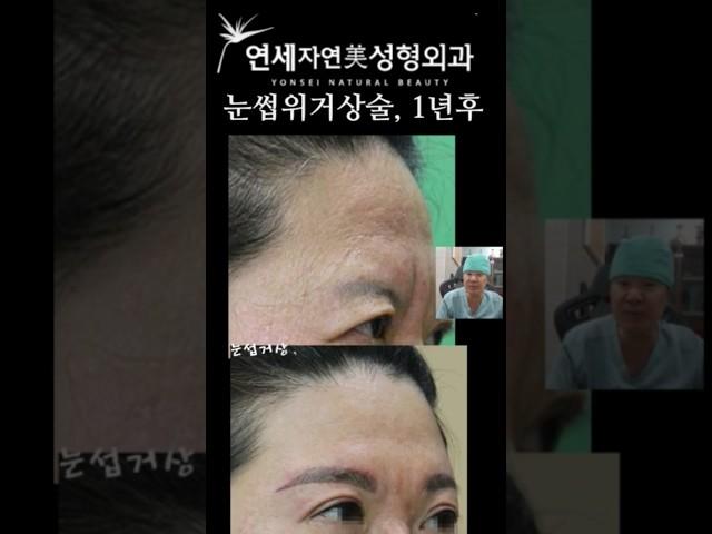 눈썹위거상술과 이마축소술 #미간주름교정 #눈썹거상 #신촌성형외과  #연세자연미성형외과 #홍대성형외과 #눈썹위거상잘하는곳  #미간주름잘하는곳 #suprabrowexcision