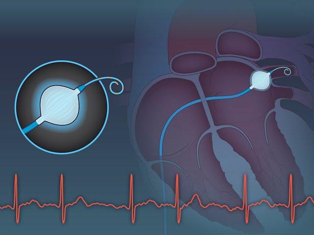 Cryoablation or Drug Therapy for Atrial Fibrillation | NEJM