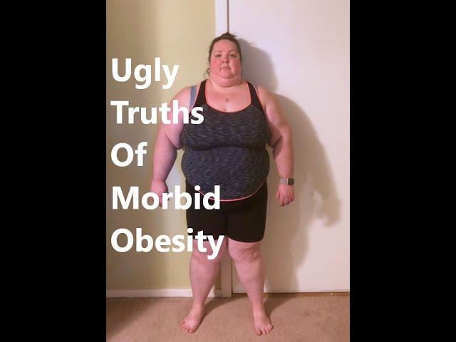 Ugly Truths of Morbid Obesity