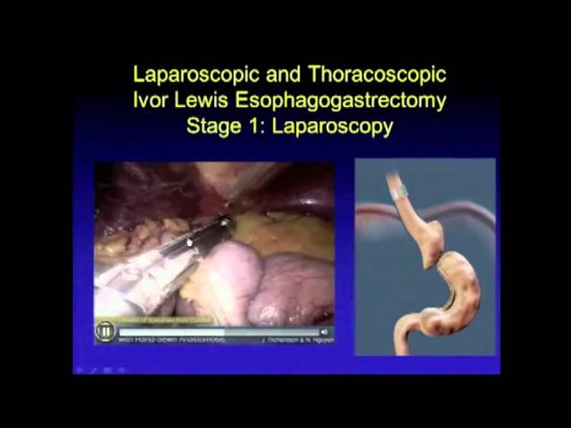 SAGES Top 21 Videos: Minimally Invasive Esophagectomy