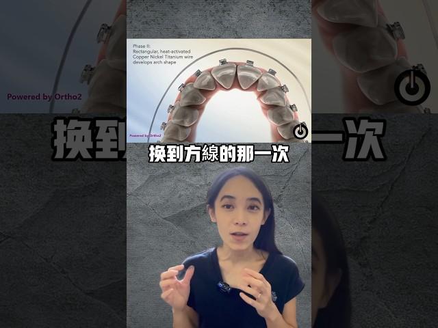 這兩個時間點是戴牙套最痛的時後#牙齒矯正#戴牙套