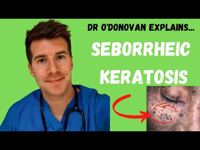 Explaining Seborrheic Keratosis | With Dr O'Donovan