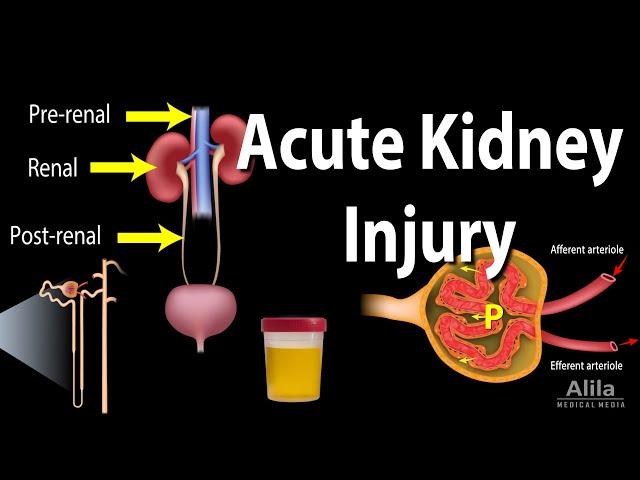 Acute Kidney Injury, a.k.a. Acute Renal Failure, Animation