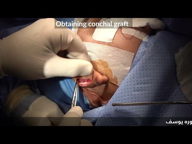Obtaining Conchal Graft-18/988: Rhinoplasty Bizrah- London/Dubai- Dr. Bashar Bizrah