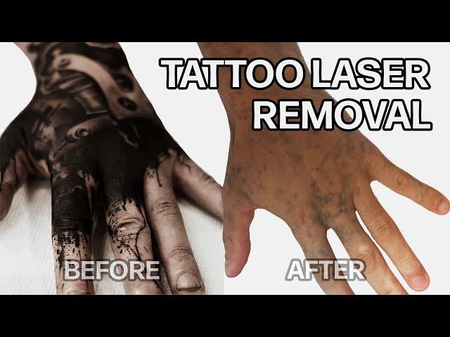 WHY DID I LASER OFF ALL MY TATTOOS? / TATTOO LASER REMOVAL