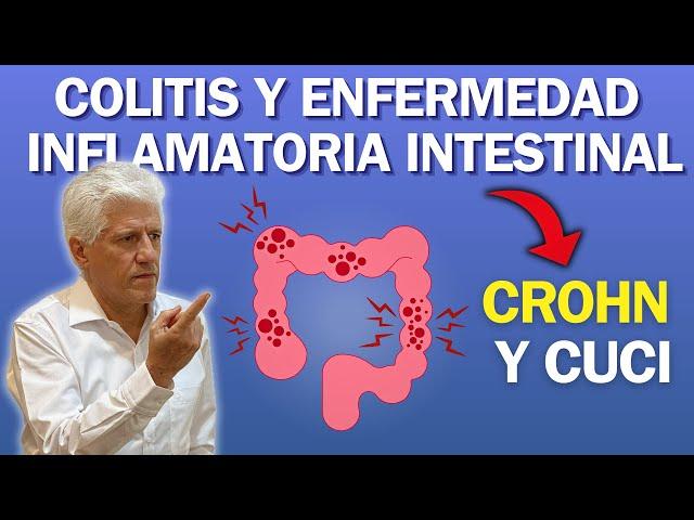 COLITIS y ENFERMEDAD INFLAMATORIA INTESTINAL (Crohn y CUCI)