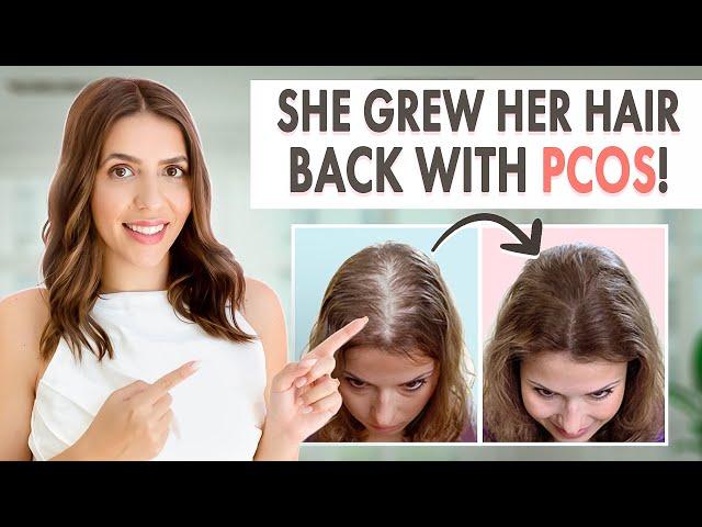 How Stephanie Grew Her Hair Back | Her PCOS Hair Loss Journey & Treatment!