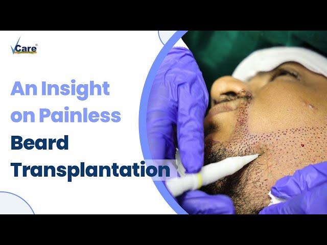 Struggling with a patchy beard? | Treat it with a painless Beard Transplantation