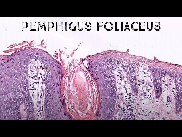 Pemphigus foliaceus (autoimmune skin blister immunobullous disease in pemphigus vulgaris family)