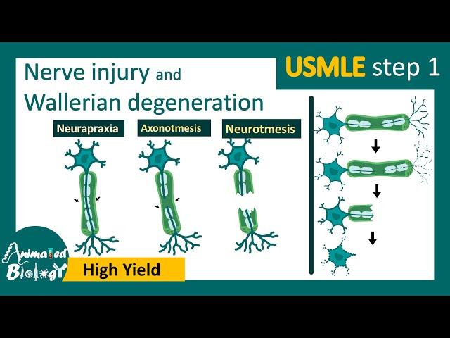 Nerve injury | Wallerian degeneration | Mechanism of  wallerian degeneration | USMLE