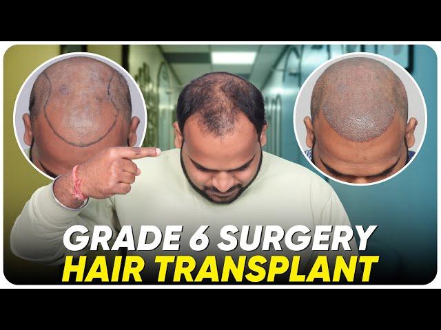 Hair Transplant in Bikaner | Best Results & Cost of Hair Transplant in Bikaner