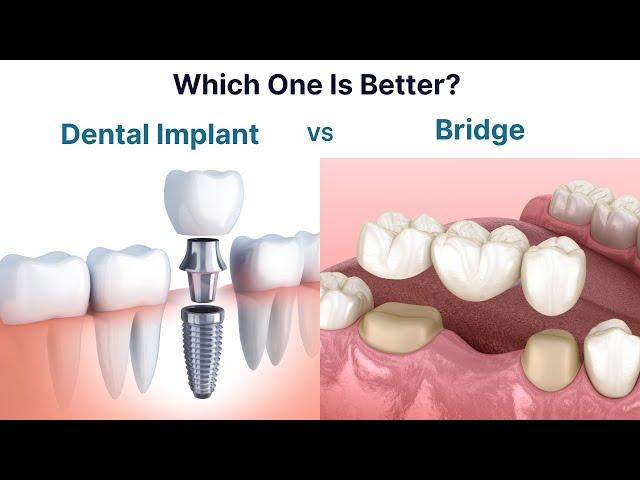 Dental Implant vs Bridge. Which one is better to replace a missing tooth?