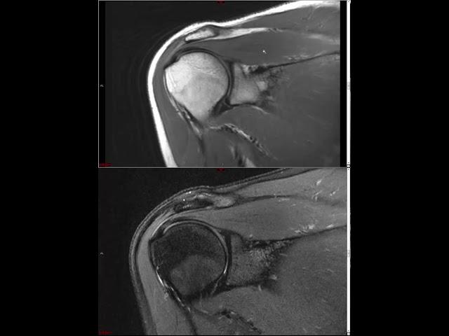 Shoulder MRI (Approach to MSK MRI Series)