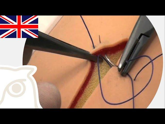 CSL: Vertical mattress suture pattern